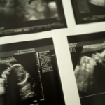 NIH Launches Multimillion-Dollar Initiative to Reduce Stillbirth Rate
